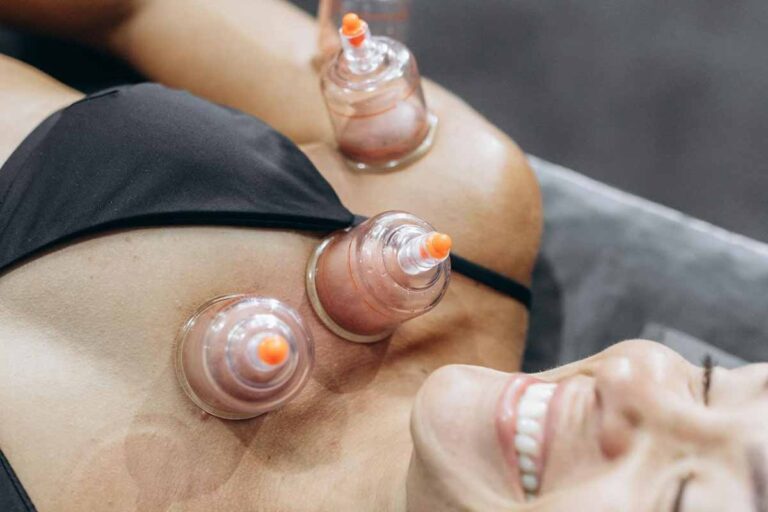 cupping-vancouver
